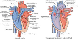 Illustrasjonsbilde av hjertefeilen: Transposisjon av de store arterier (TGA)