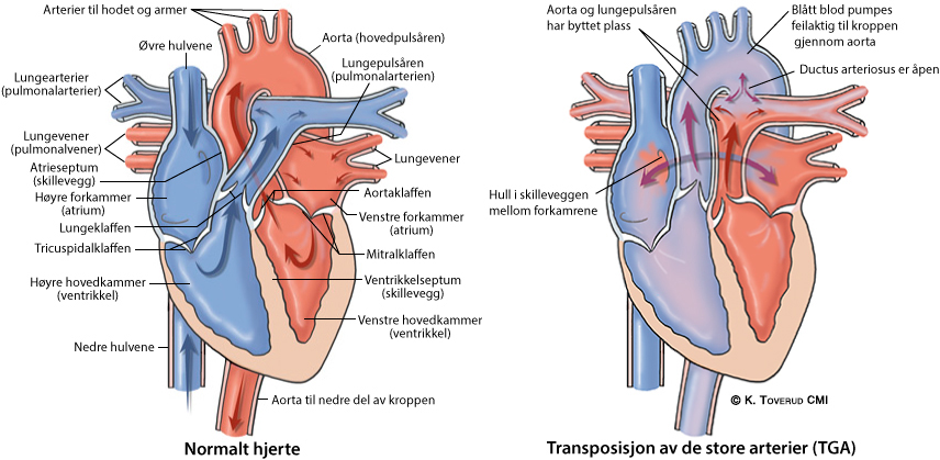 Illustrasjonsbilde av hjertefeilen: Transposisjon av de store arterier (TGA)