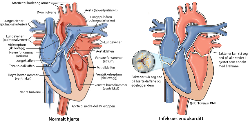 Illustrasjonsbilde av hjertefeilen: Infeksiøs endokarditt