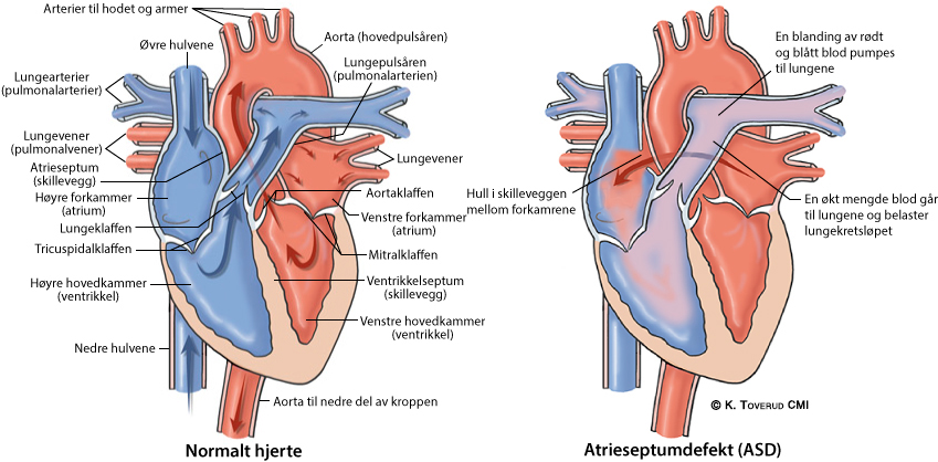 Illustrasjonsbilde av hjertefeilen: Artrieseptumdefekt (ASD)