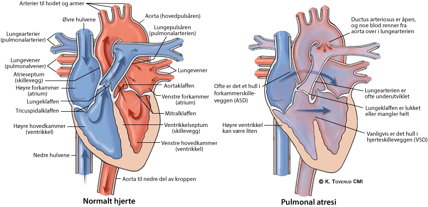 Illustrasjonsbilde av hjertefeilen: Pulmonal atresi