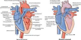Illustrasjonsbilde av hjertefeilen: Ebsteins anomali