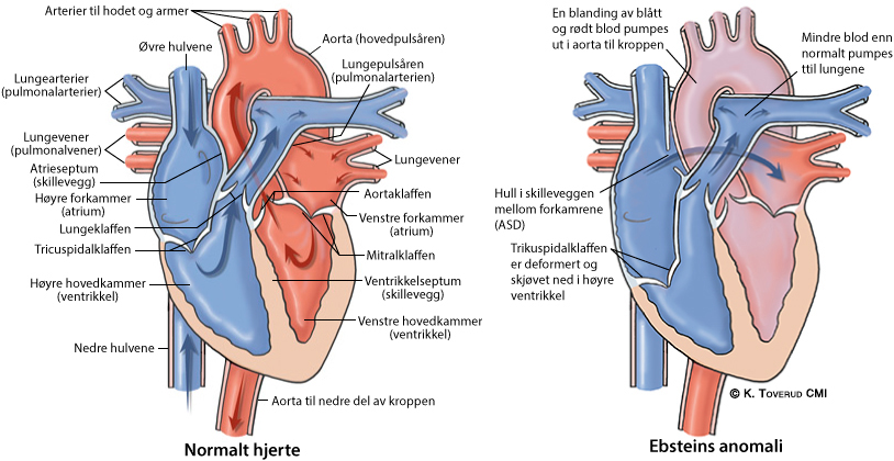 Illustrasjonsbilde av hjertefeilen: Ebsteins anomali