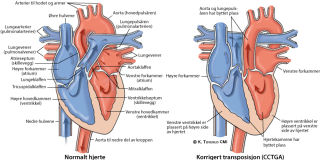 Illustrasjonsbilde av hjertefeilen: Korrigert transposisjon