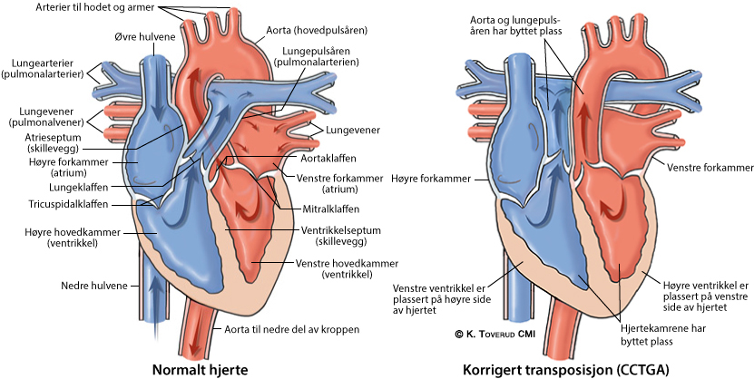 Illustrasjonsbilde av hjertefeilen: Korrigert transposisjon