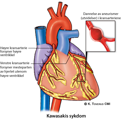 Illustrasjonsbilde av hjertefeilen: Kawasakis sykdom