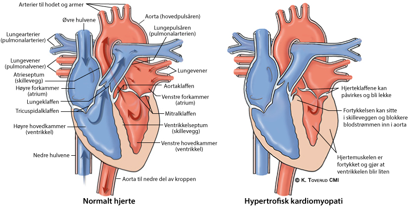 Illustrasjonsbilde av hjertefeilen: Hypertrofisk kardiomyopati (HCM)