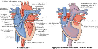 Illustrasjonsbilde av hjertefeilen: Hypoplastisk venstre hjertesyndrom (HVHS/HLHS)