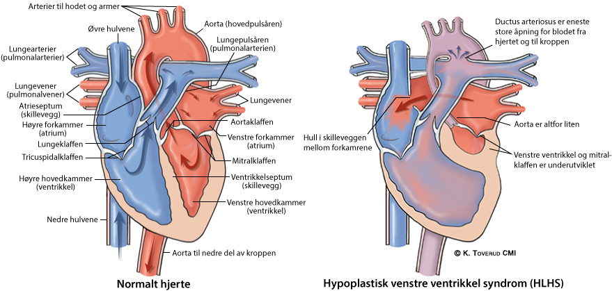 Illustrasjonsbilde av hjertefeilen: Hypoplastisk venstre hjertesyndrom (HVHS/HLHS)