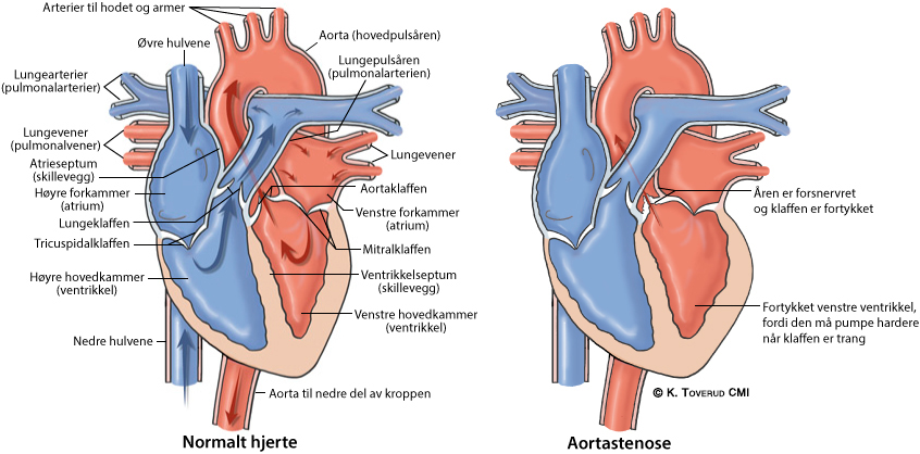 Illustrasjonsbilde av hjertefeilen: Aortastense