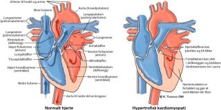 Illustrasjon av hjertefeilen hypertrofisk kardiomyopati