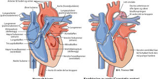 Illustrasjonsbilde av hjertefeilen: Koarktasjon av aorta