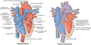 Illustrasjonsbilde av hjertefeilen: Truncus arteriosus