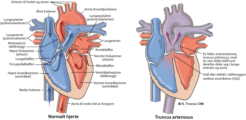Illustrasjonsbilde av hjertefeilen: Truncus arteriosus