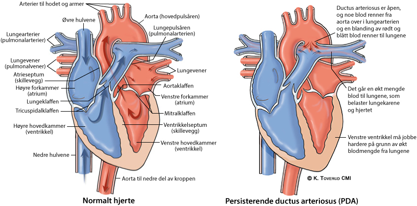 Illustrasjonsbilde av hjertefeilen: Persisterende ductus arteriosus