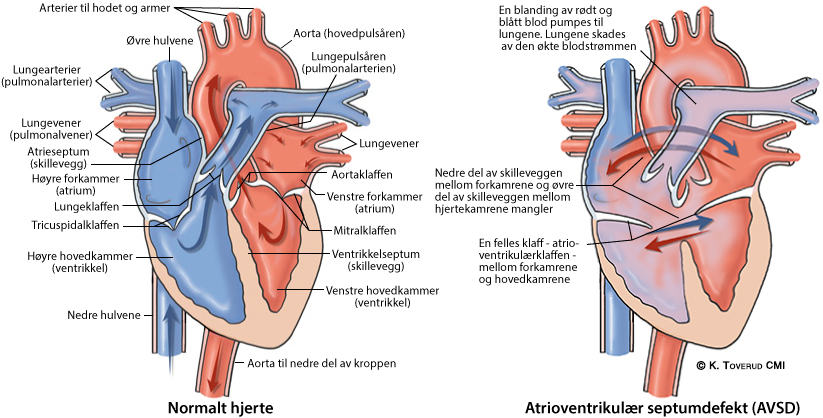 Illustrasjonsbilde av hjertefeilen: Atrioventrikulær septumdefekt (AVSD)