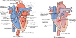 Illustrasjonsbilde av hjertefeilen: Trikuspidal atresi