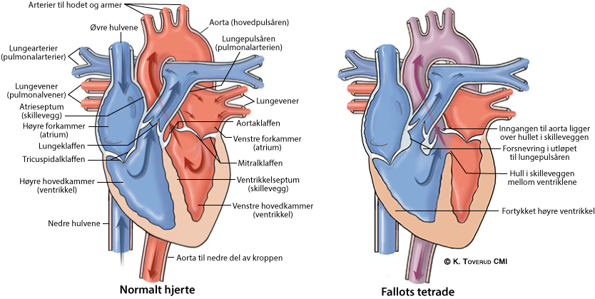 Illustrasjonsbilde av hjertefeilen: Fallots tetrade
