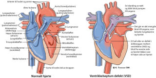 Illustrasjonsbilde av hjertefeilen: Ventrikkelseptumdefekt (VSD)