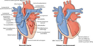 Illustrasjonsbilde av hjertefeilen: Dilatert kardiomyopati (DCM)